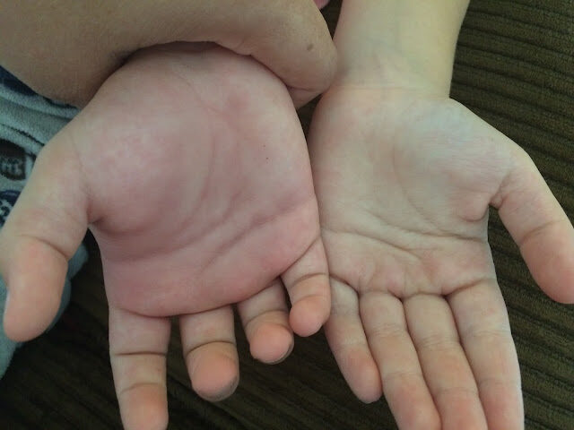 My son's two hands.  One is normal size and the other is very, very swollen.